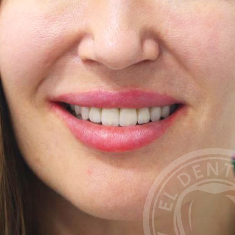 After: Smile Transformation · Case 01