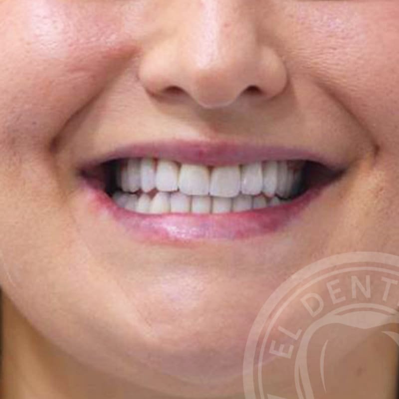 After: Smile Transformation · Case 02