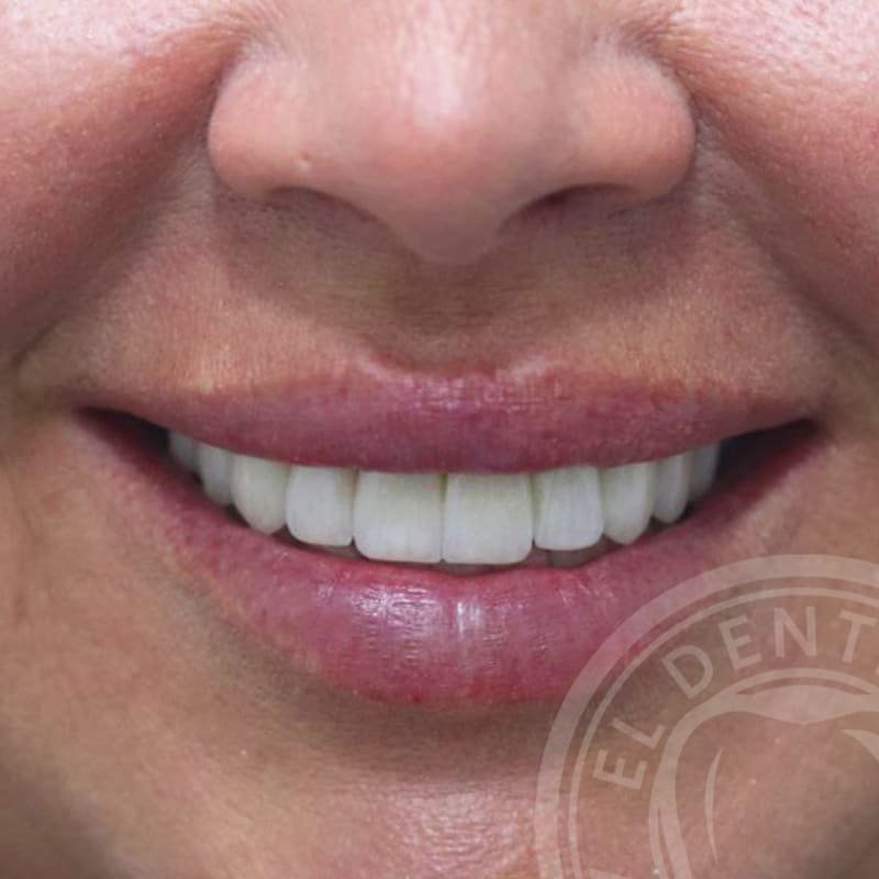 After: Smile Transformation · Case 03